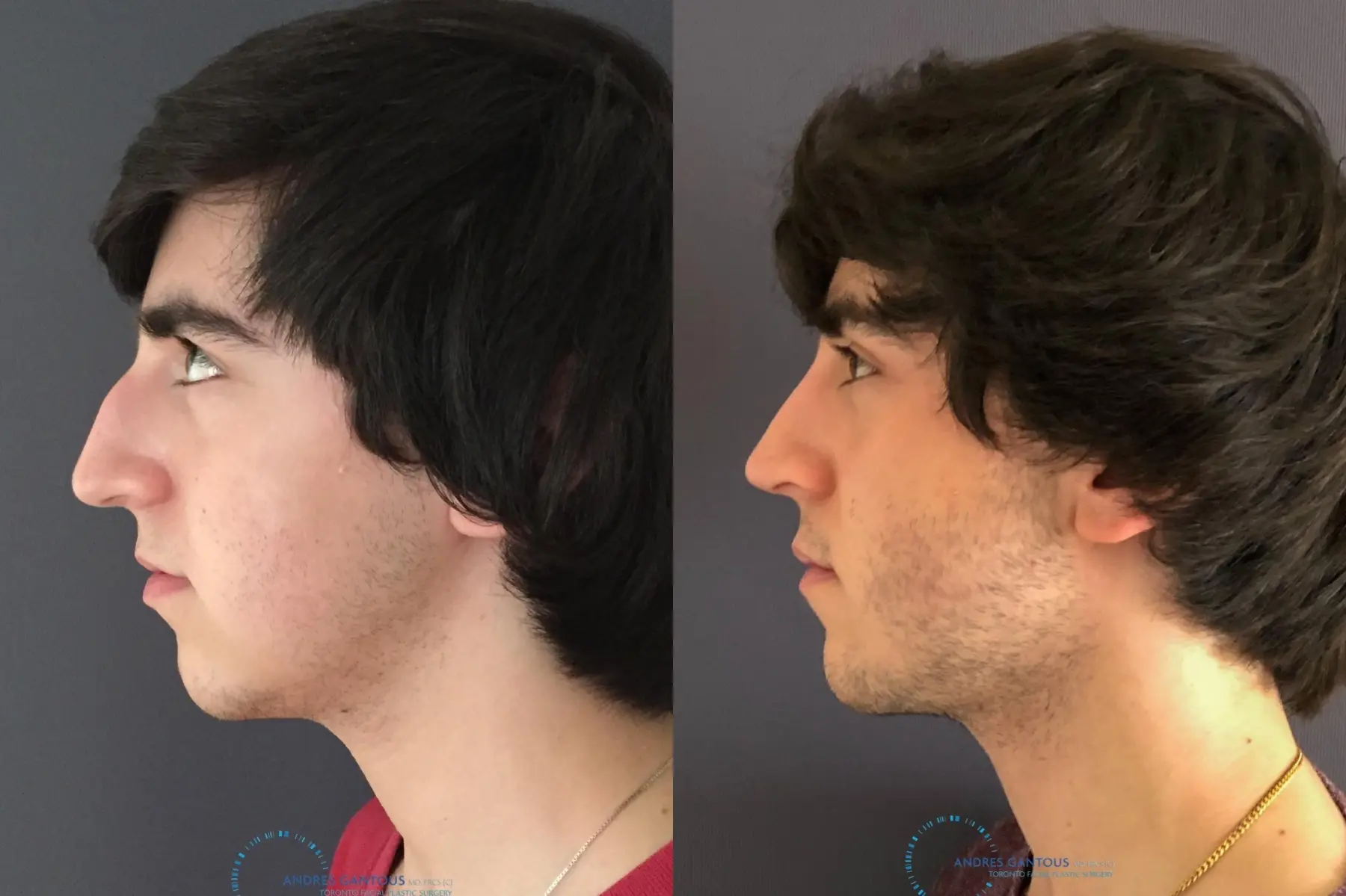 Rhinoplasty: Patient 67 - Before and After 6