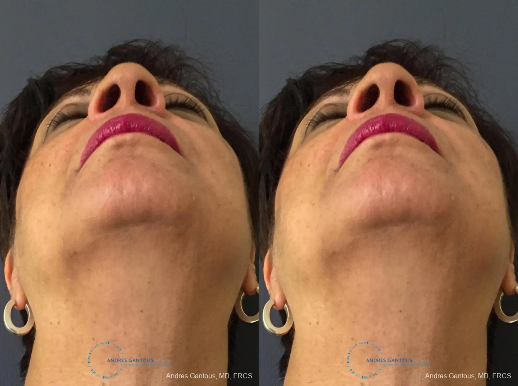 Rhinoplasty: Patient 91 - Before and After 2