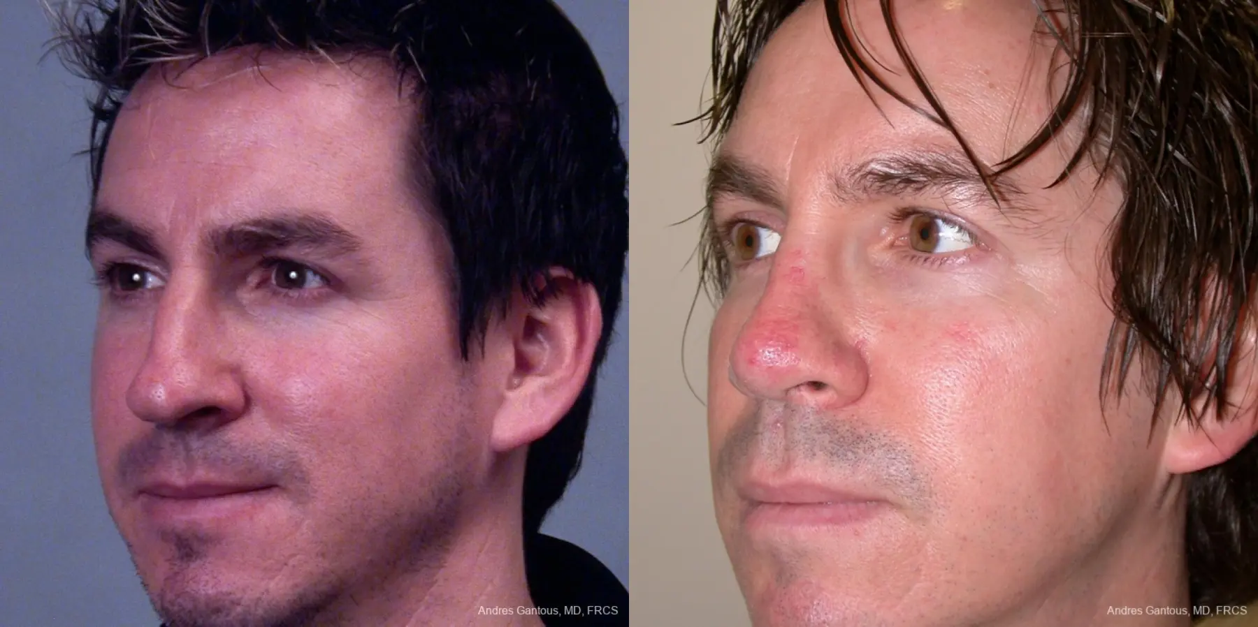 Rhinoplasty: Patient 39 - Before and After 2