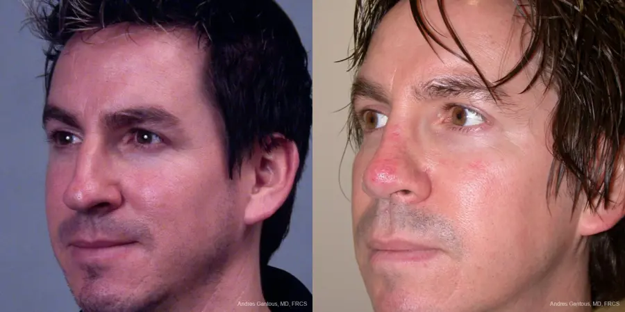 Rhinoplasty: Patient 39 - Before and After 2