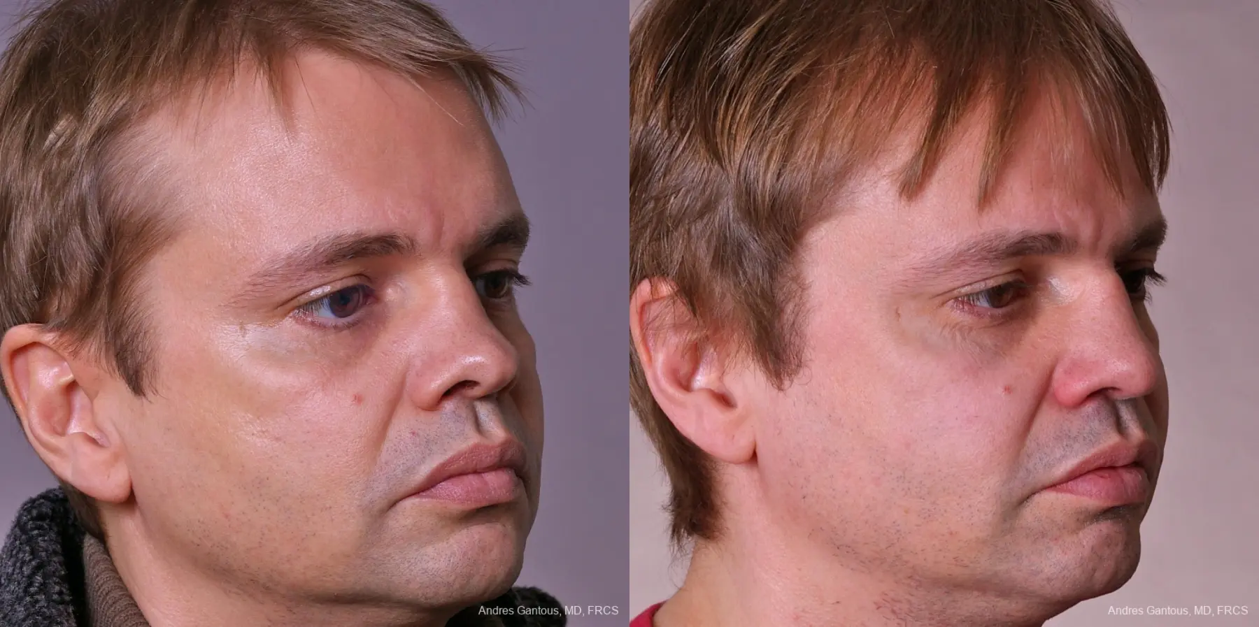 Rhinoplasty: Patient 38 - Before and After 2