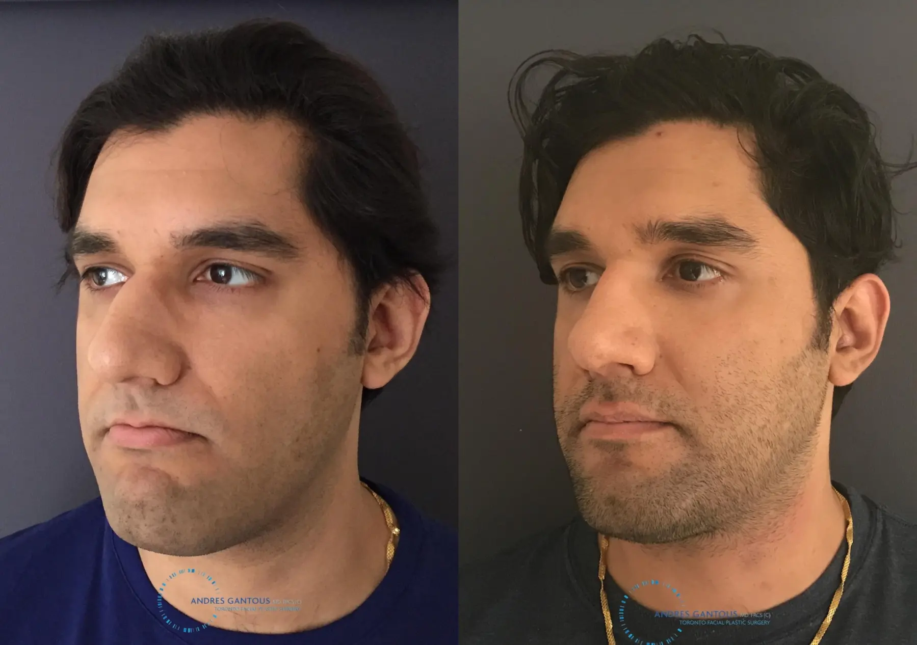 Rhinoplasty: Patient 60 - Before and After 4