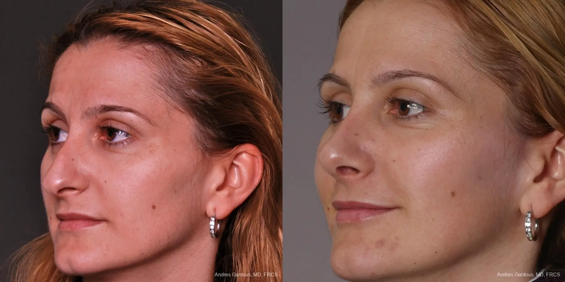 Rhinoplasty: Patient 34 - Before and After 3