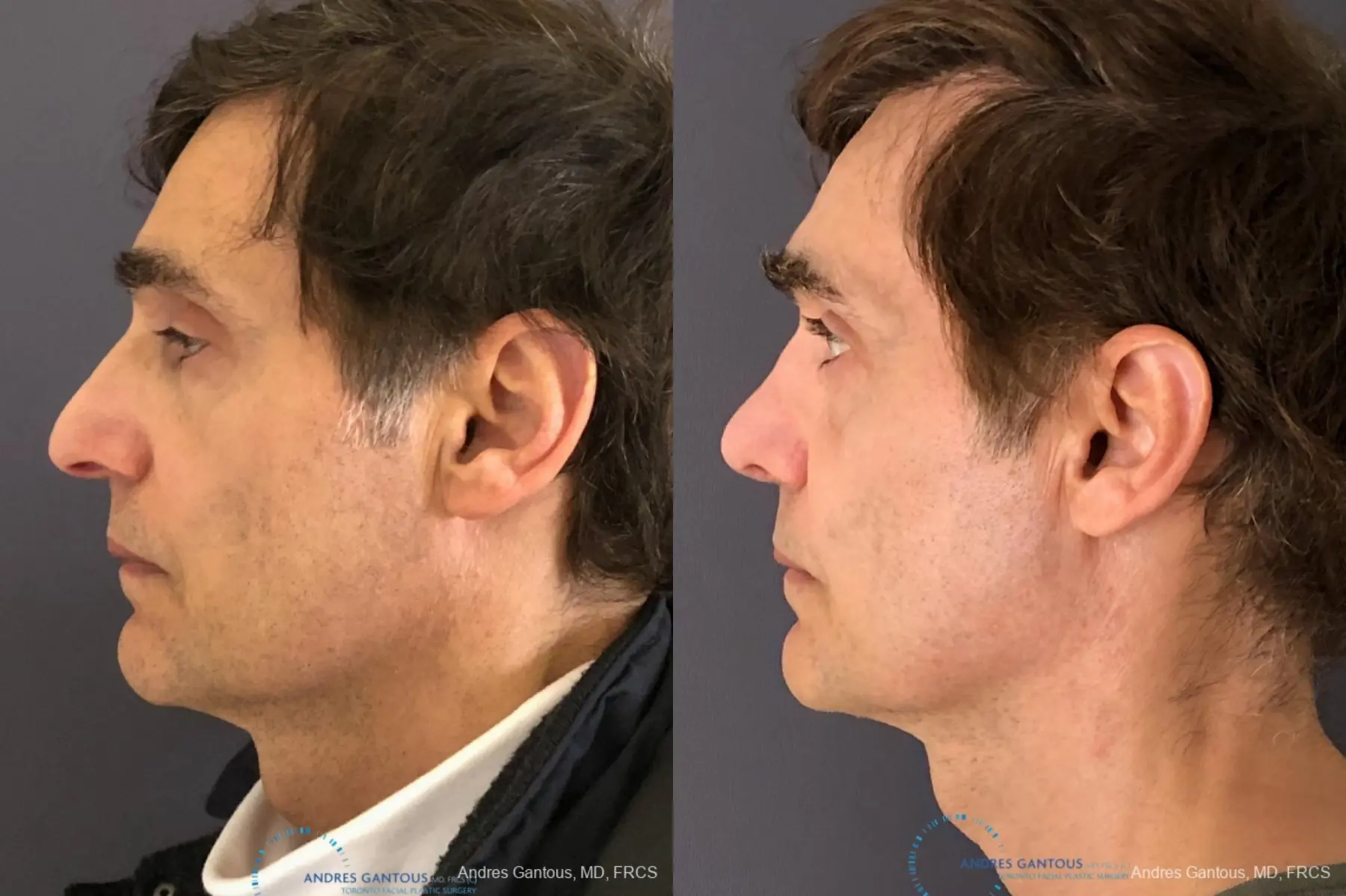 Rhinoplasty: Patient 78 - Before and After 6