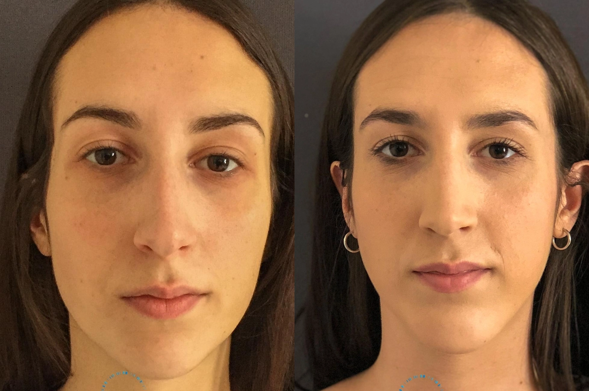 Before and after procedure result
