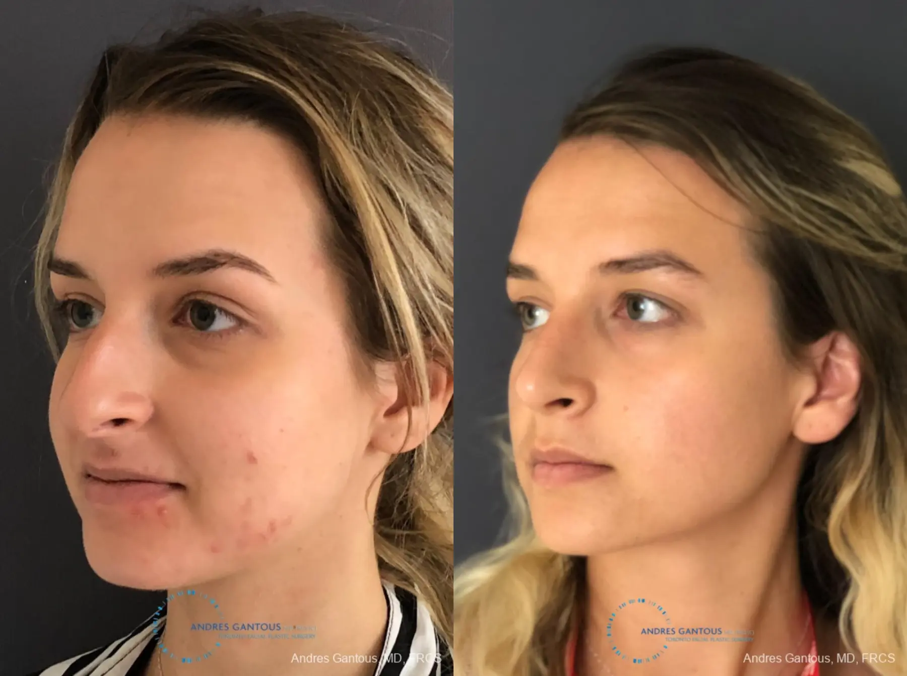 Rhinoplasty: Patient 86 - Before and After 4