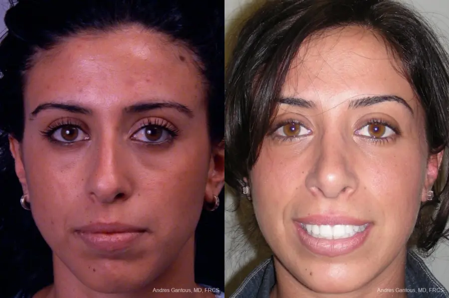 Rhinoplasty: Patient 14 - Before and After 1