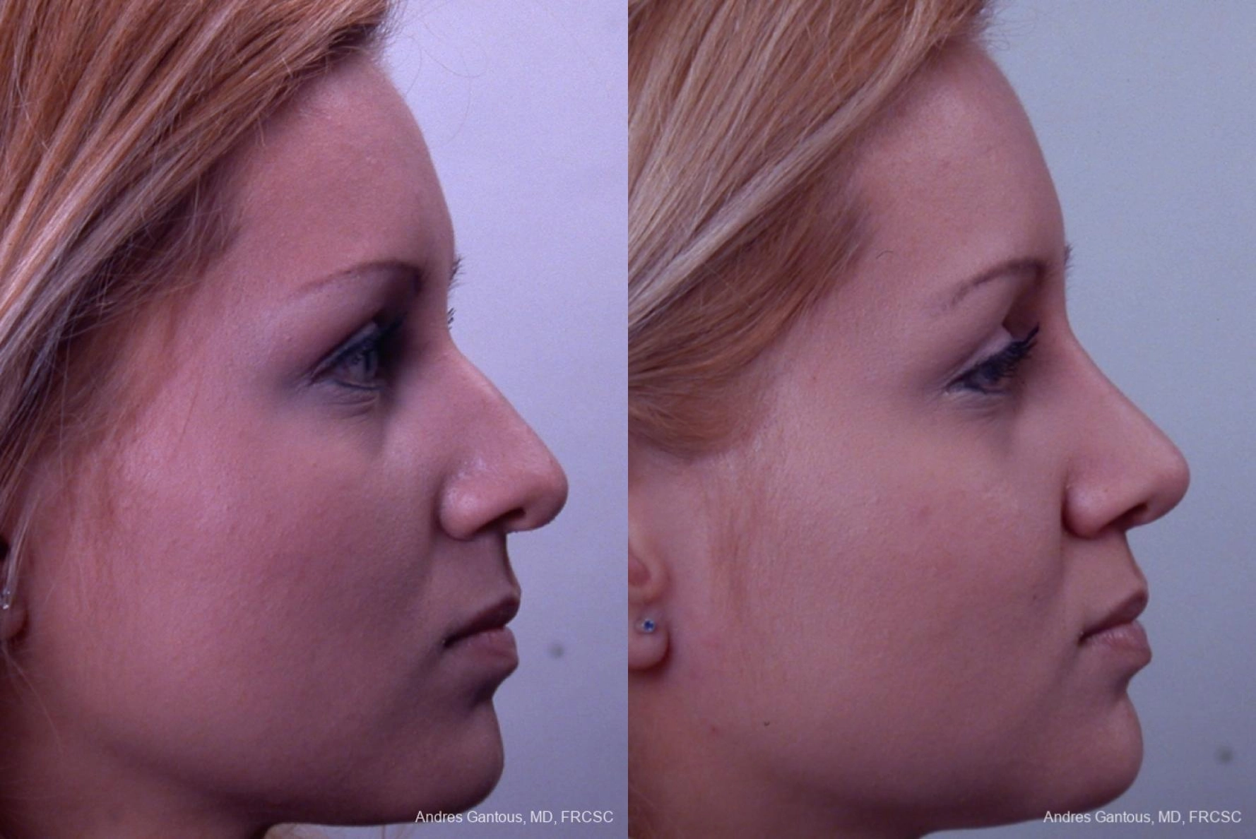 Rhinoplasty - Thumbnail 3