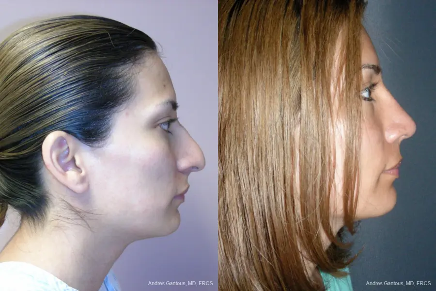 Rhinoplasty: Patient 56 - Before and After 3