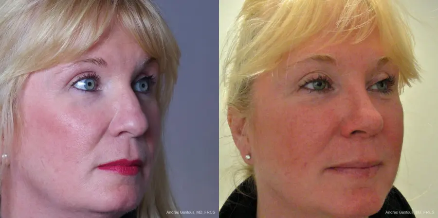 Rhinoplasty: Patient 37 - Before and After 2