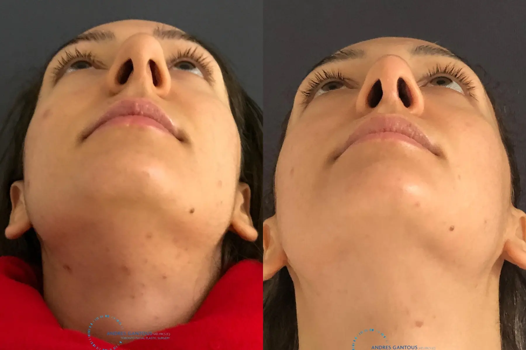 Rhinoplasty: Patient 59 - Before and After 2
