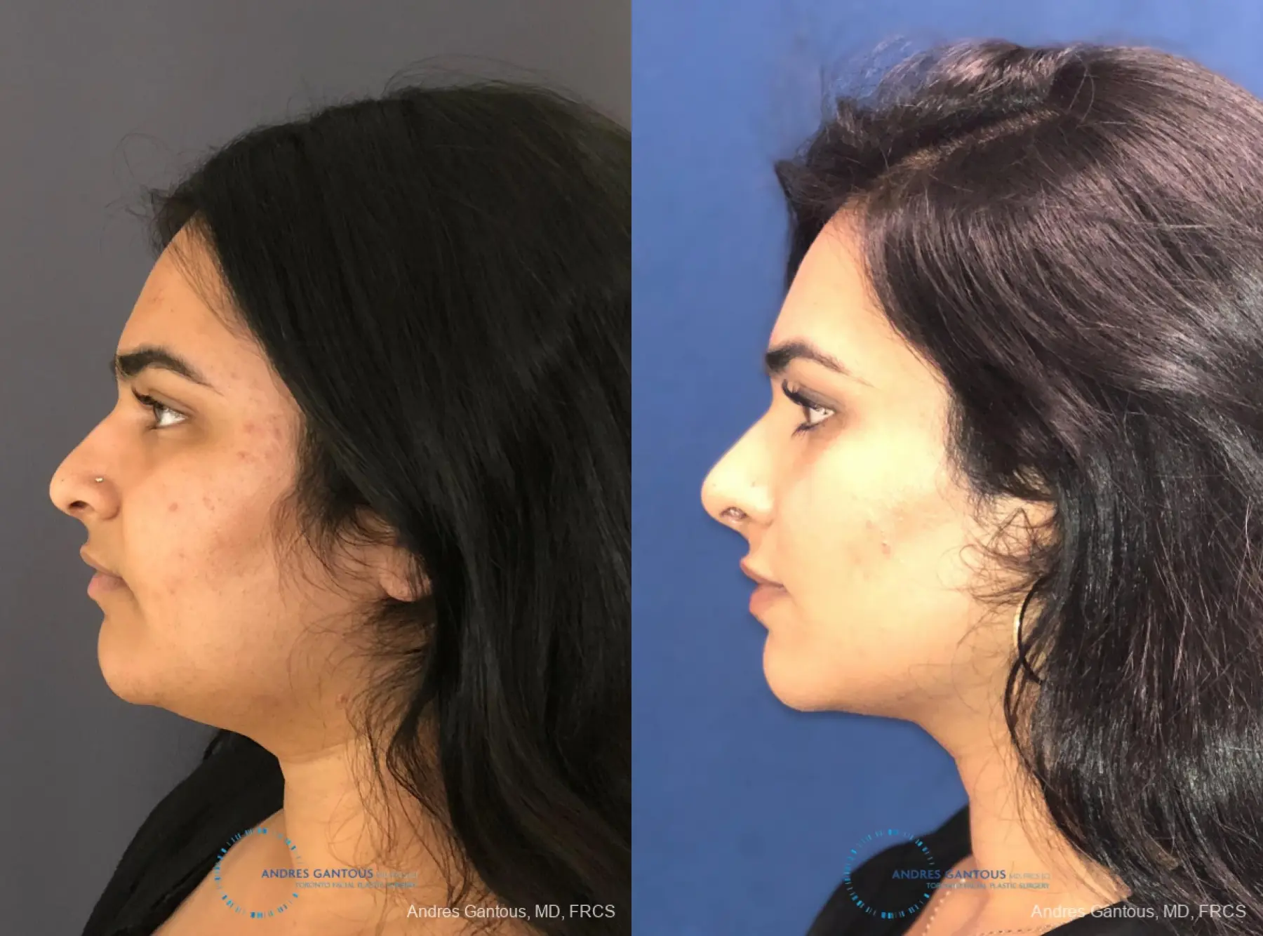 Rhinoplasty: Patient 84 - Before and After 6