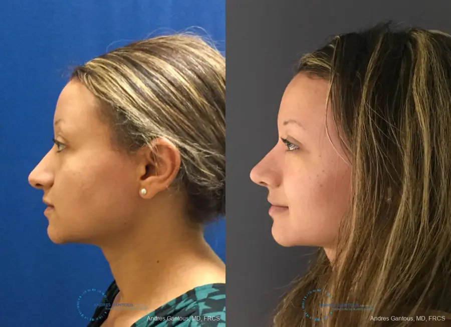Rhinoplasty: Patient 93 - Before and After 6
