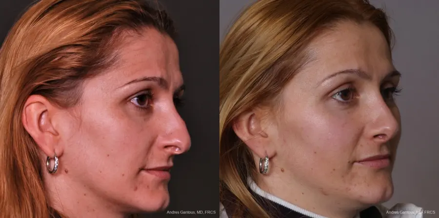 Rhinoplasty: Patient 34 - Before and After 2