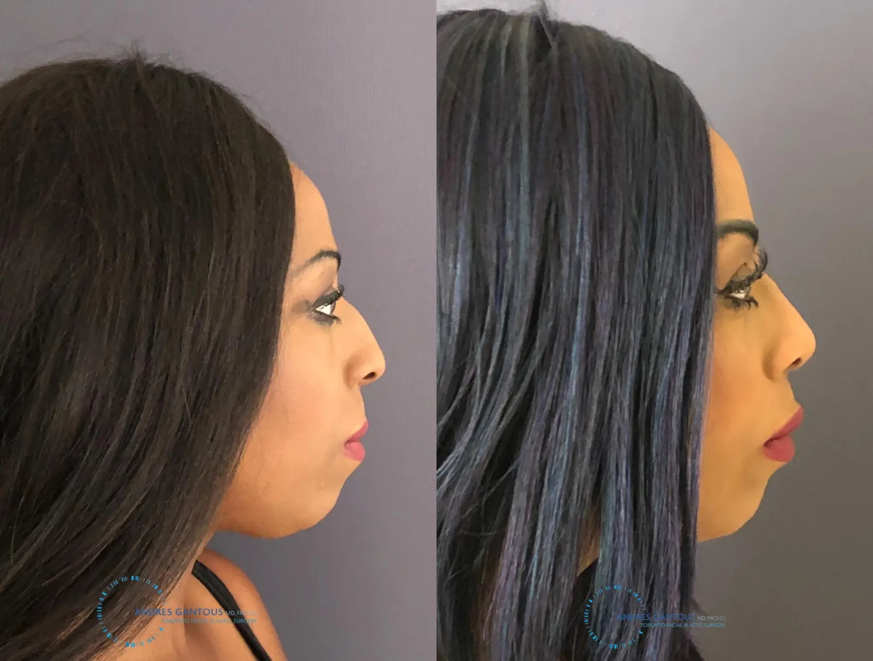 Rhinoplasty: Patient 64 - Before and After 6