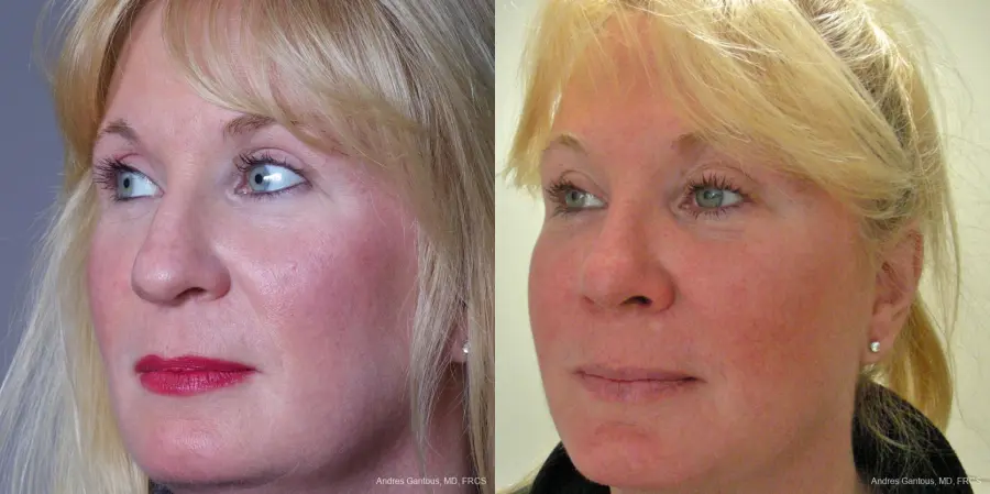 Rhinoplasty: Patient 37 - Before and After 3