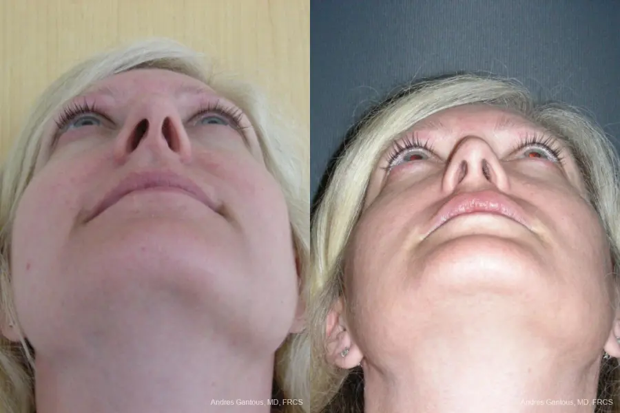 Rhinoplasty: Patient 44 - Before and After 6