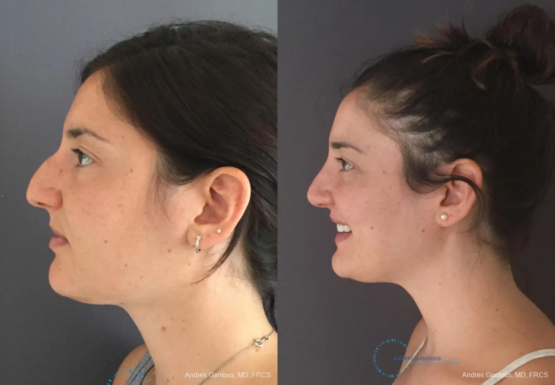 Rhinoplasty: Patient 81 - Before and After 6