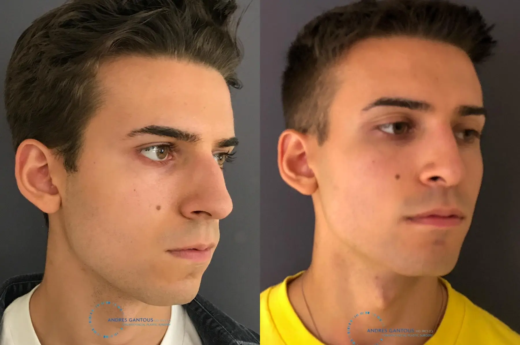 Rhinoplasty: Patient 65 - Before and After 4