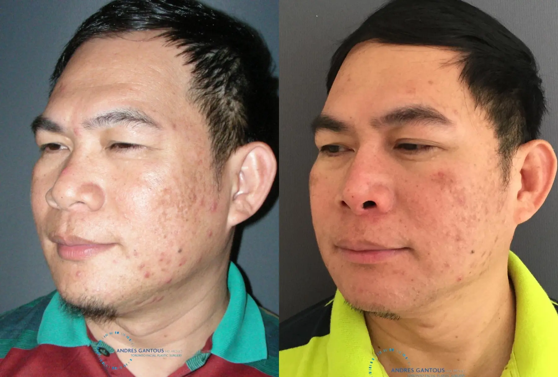 Rhinoplasty: Patient 61 - Before and After 4