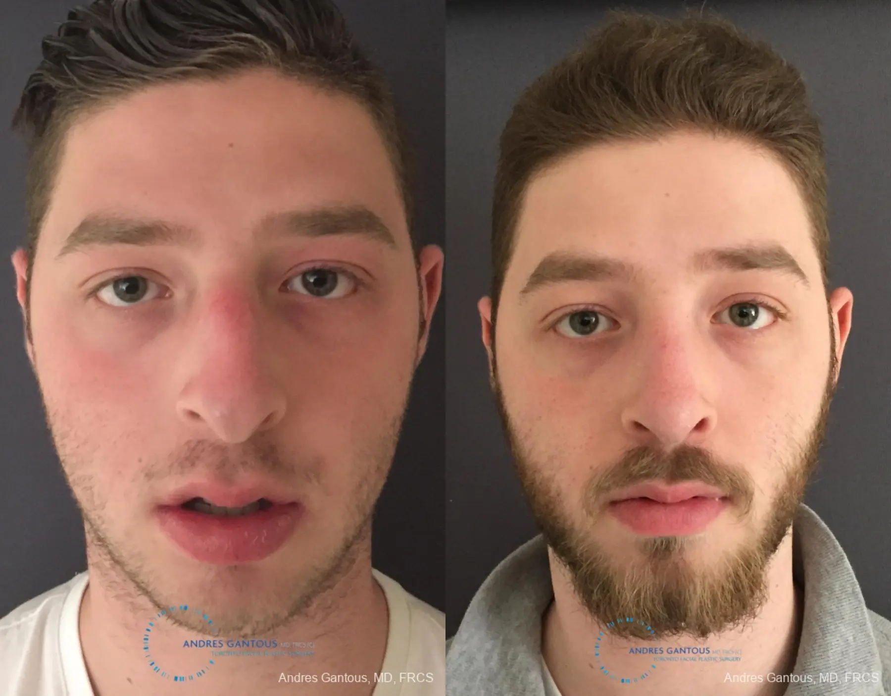 Rhinoplasty: Patient 96 - Before and After 1