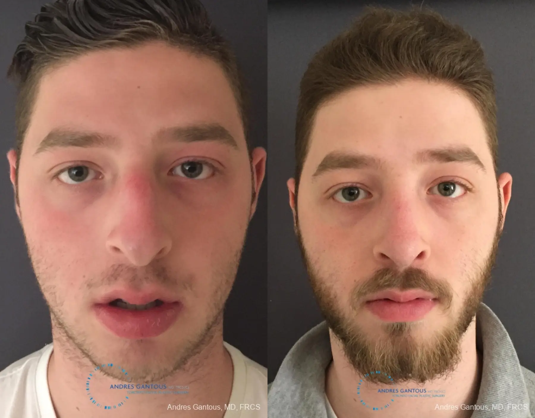 Rhinoplasty: Patient 94 - Before and After  