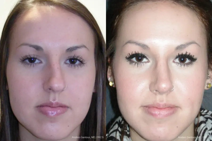 Rhinoplasty: Patient 21 - Before and After 1