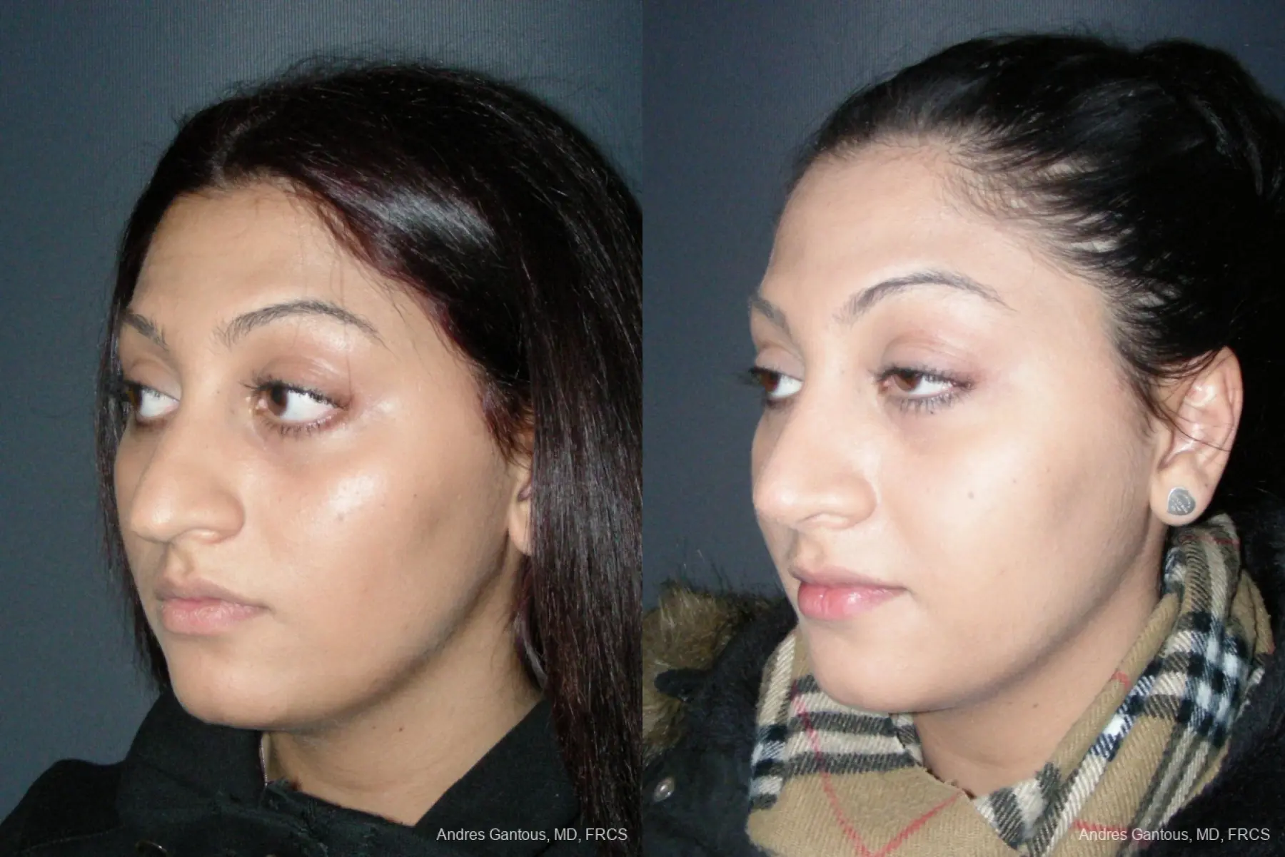 Rhinoplasty: Patient 45 - Before and After 4