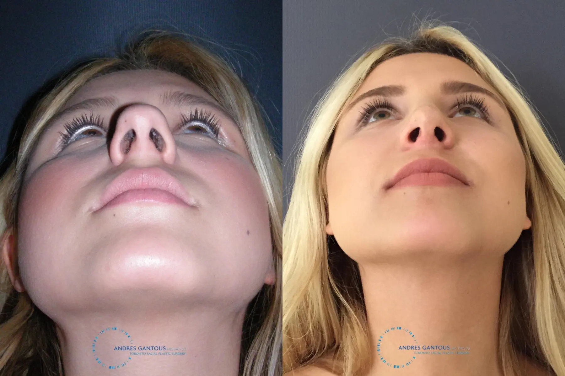 Rhinoplasty: Patient 70 - Before and After 2
