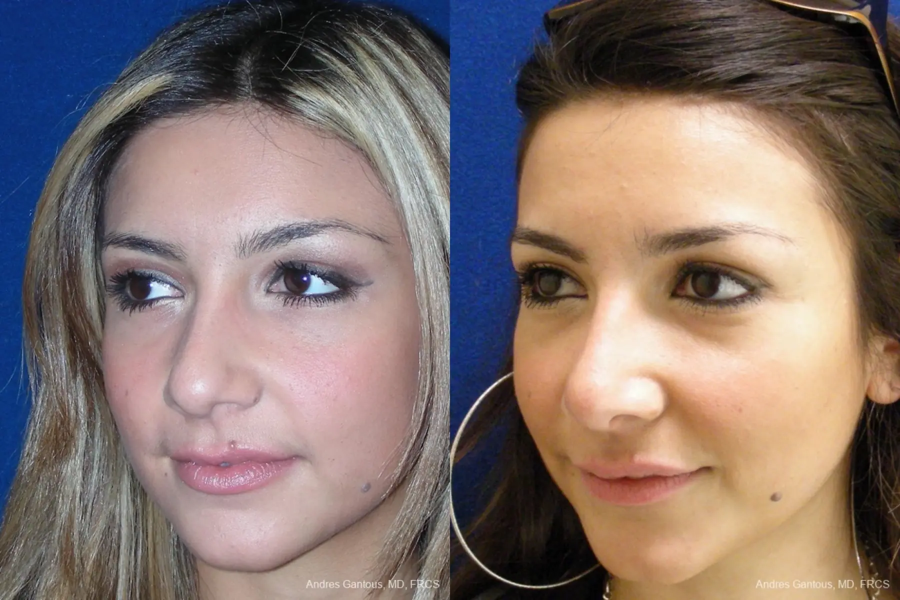 Rhinoplasty: Patient 29 - Before and After 3