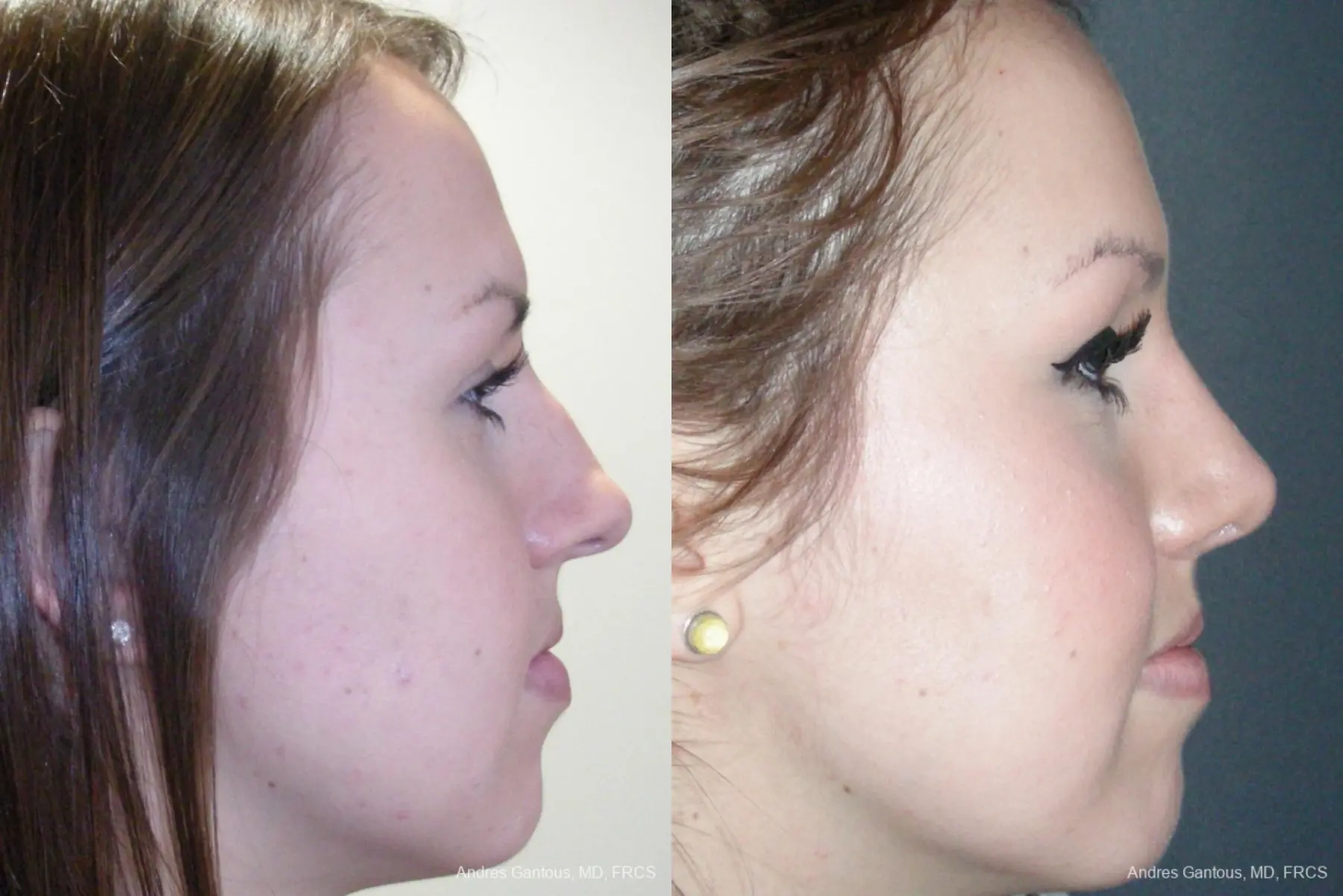 Rhinoplasty: Patient 21 - Before and After 5