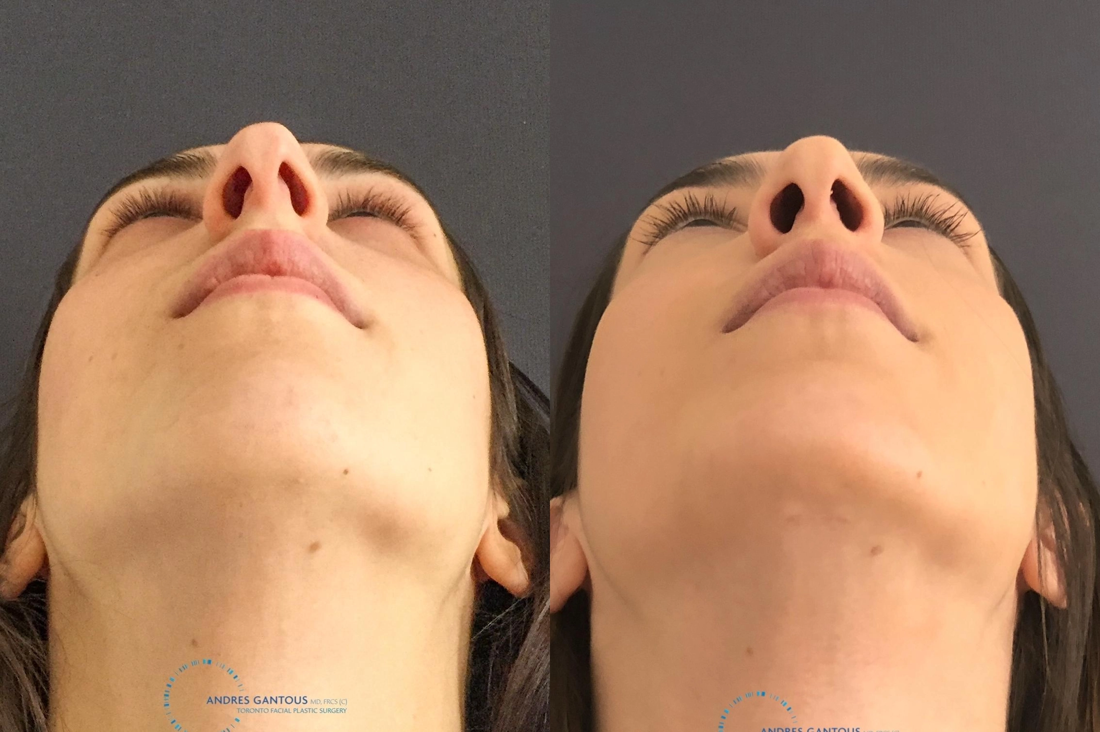 Rhinoplasty - Thumbnail 2