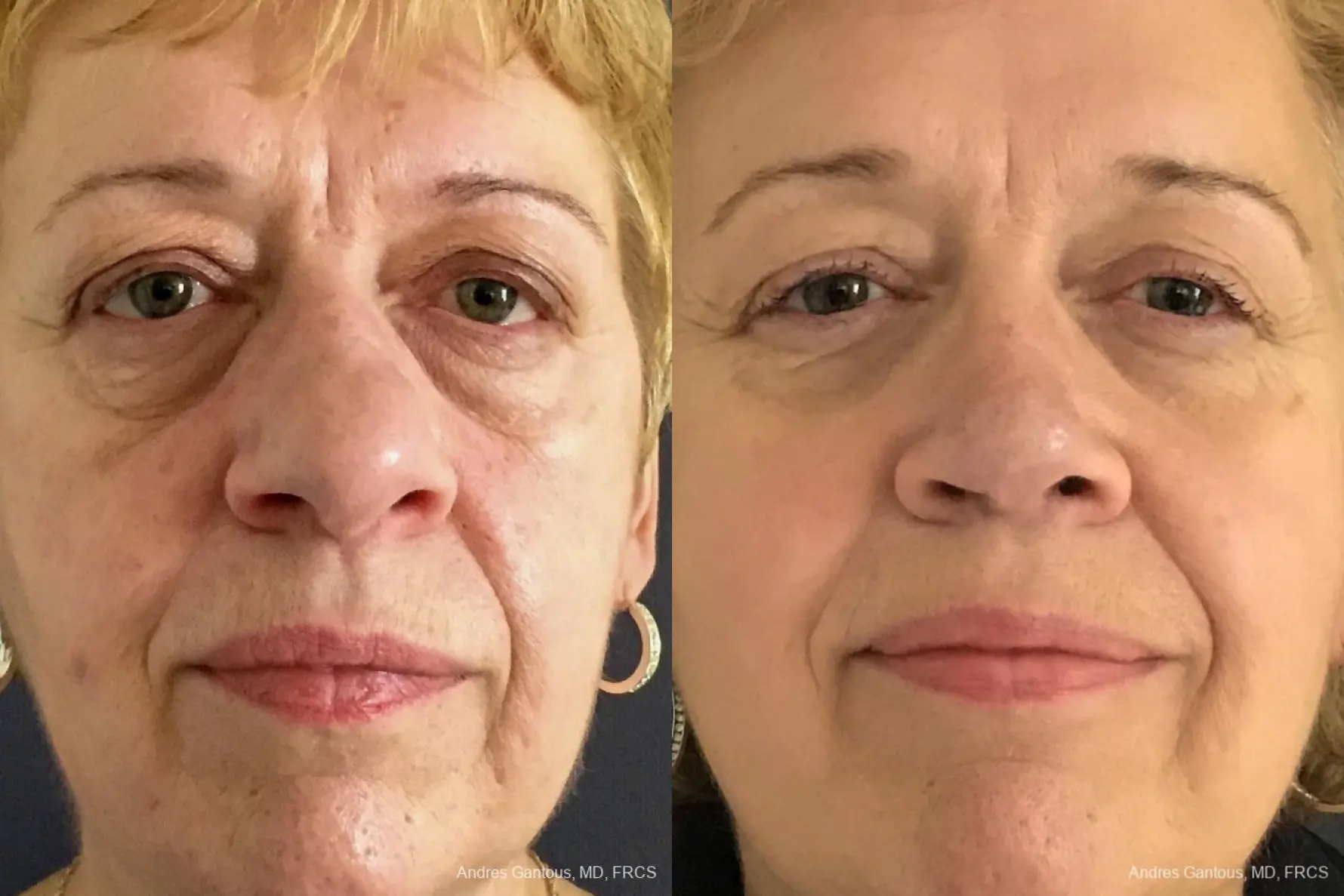 Rhinoplasty: Patient 20 - Before and After 1