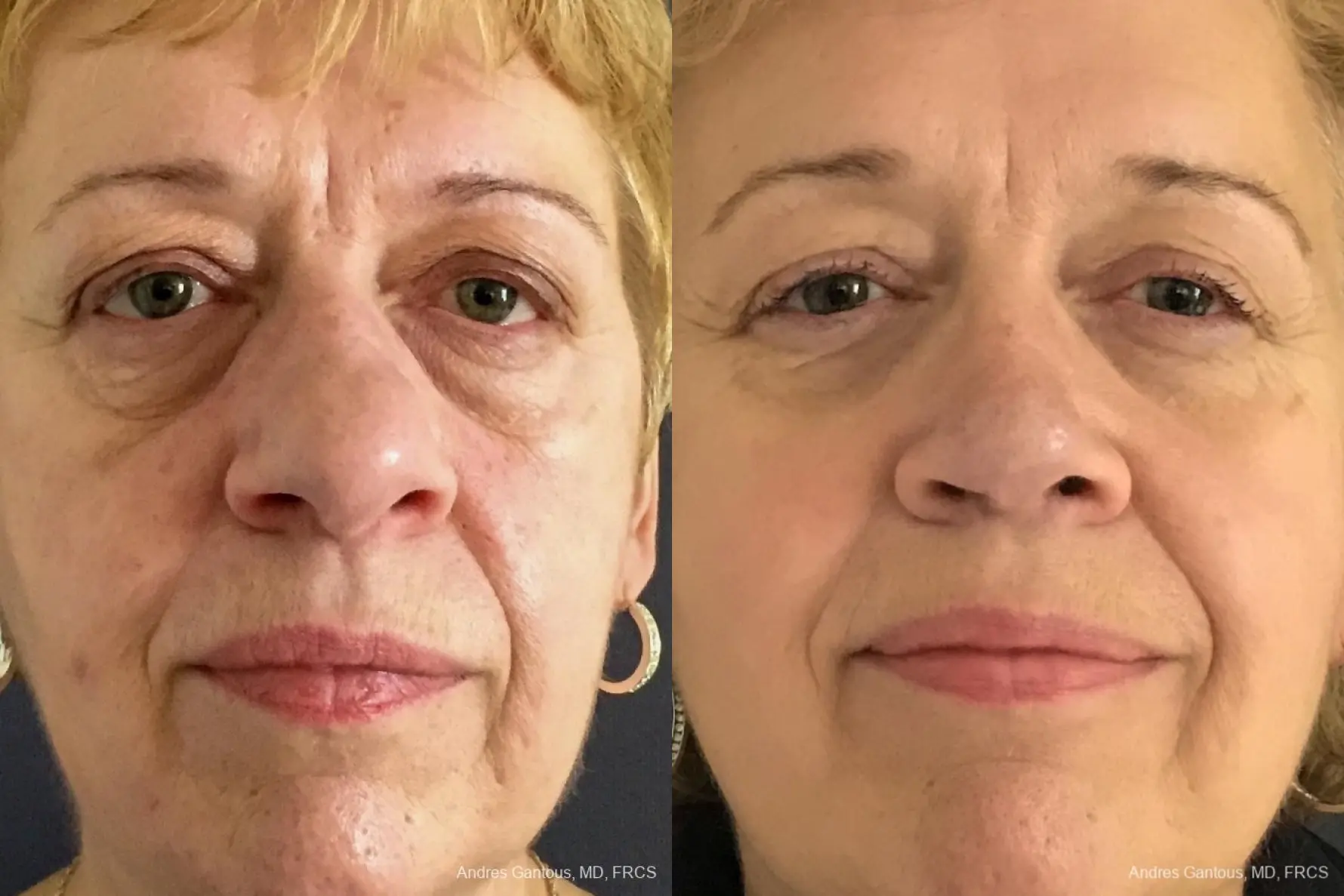 Rhinoplasty: Patient 20 - Before and After  