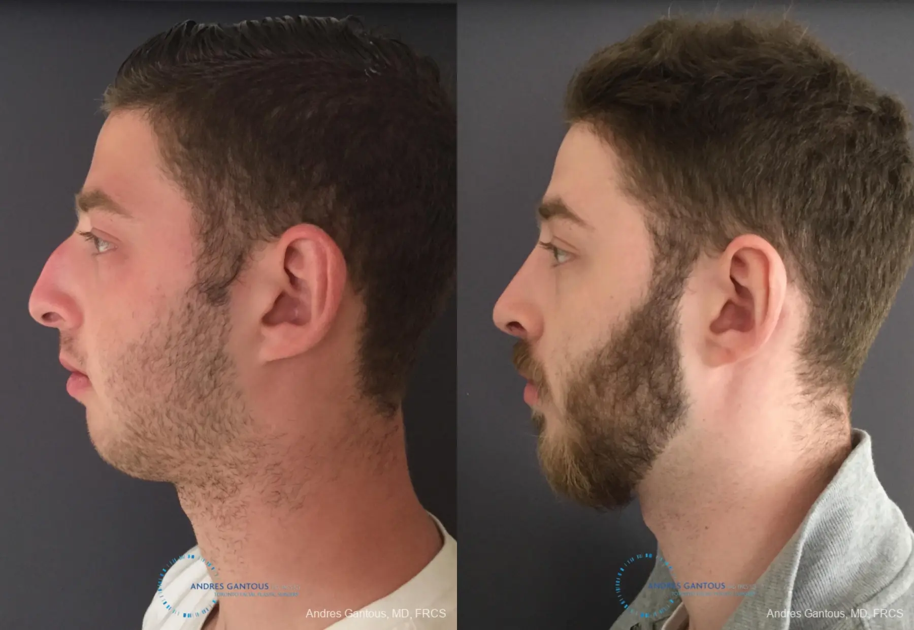 Rhinoplasty: Patient 96 - Before and After 6