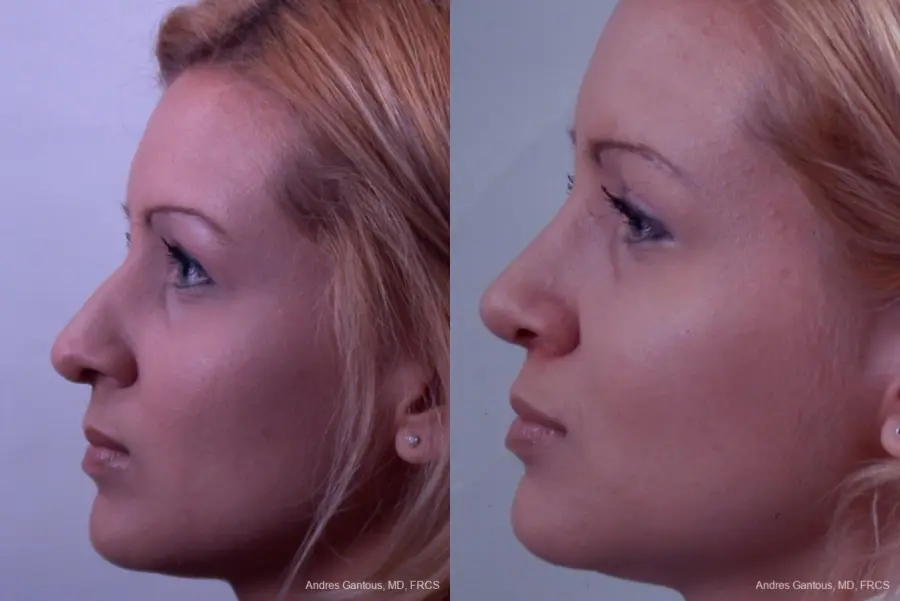 Rhinoplasty: Patient 22 - Before and After 4