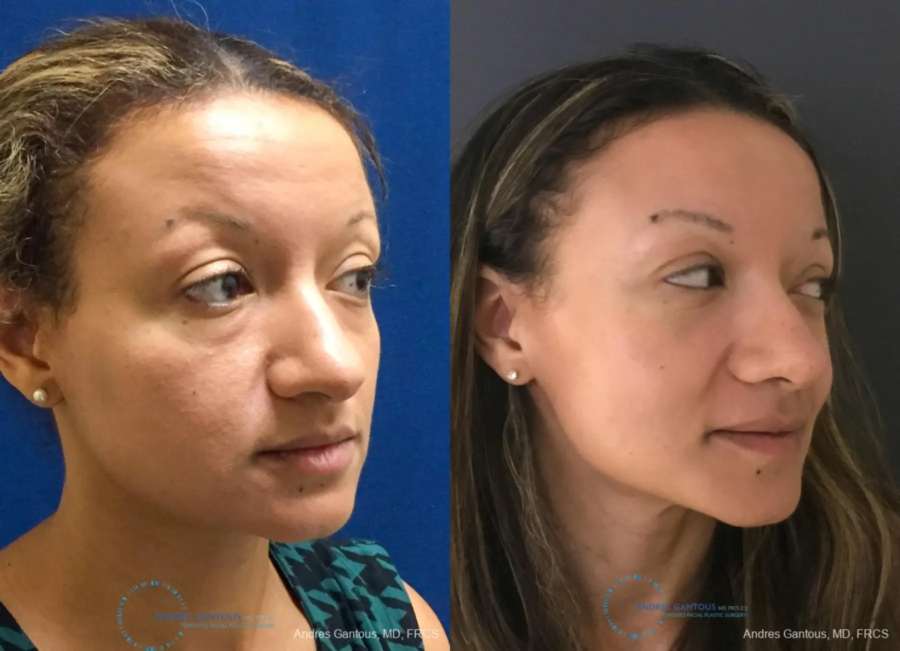 Rhinoplasty: Patient 93 - Before and After 3