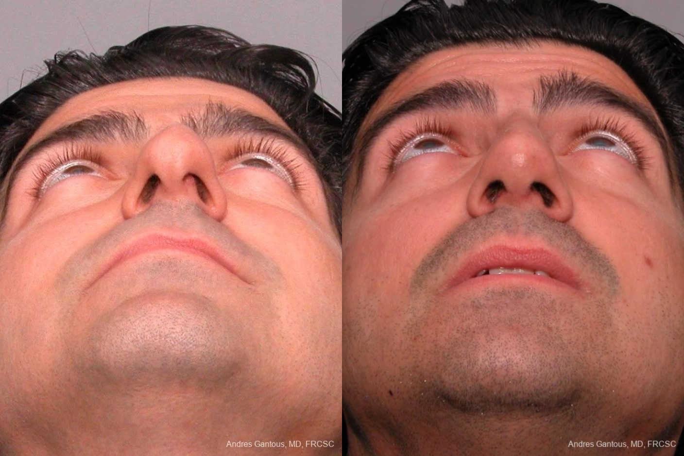 Rhinoplasty - Thumbnail 2