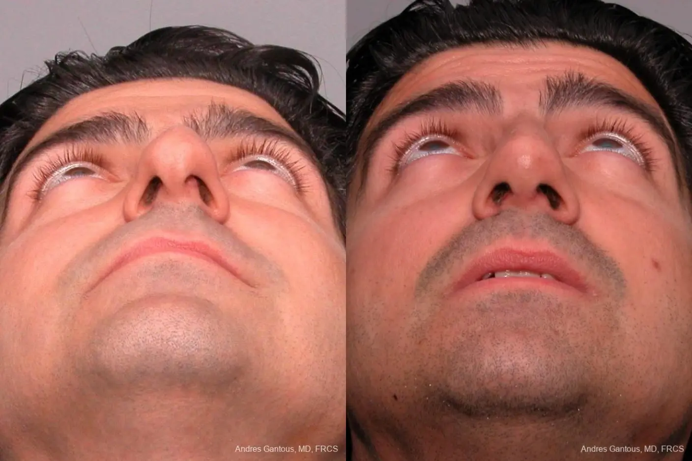 Rhinoplasty: Patient 24 - Before and After 2