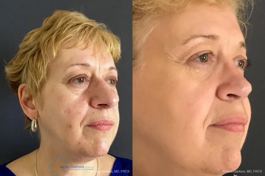 Rhinoplasty: Patient 20 - Before and After 4