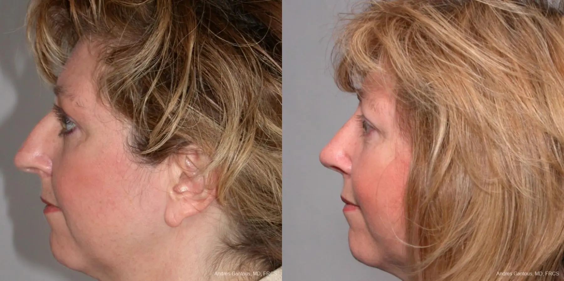 Rhinoplasty: Patient 35 - Before and After 3