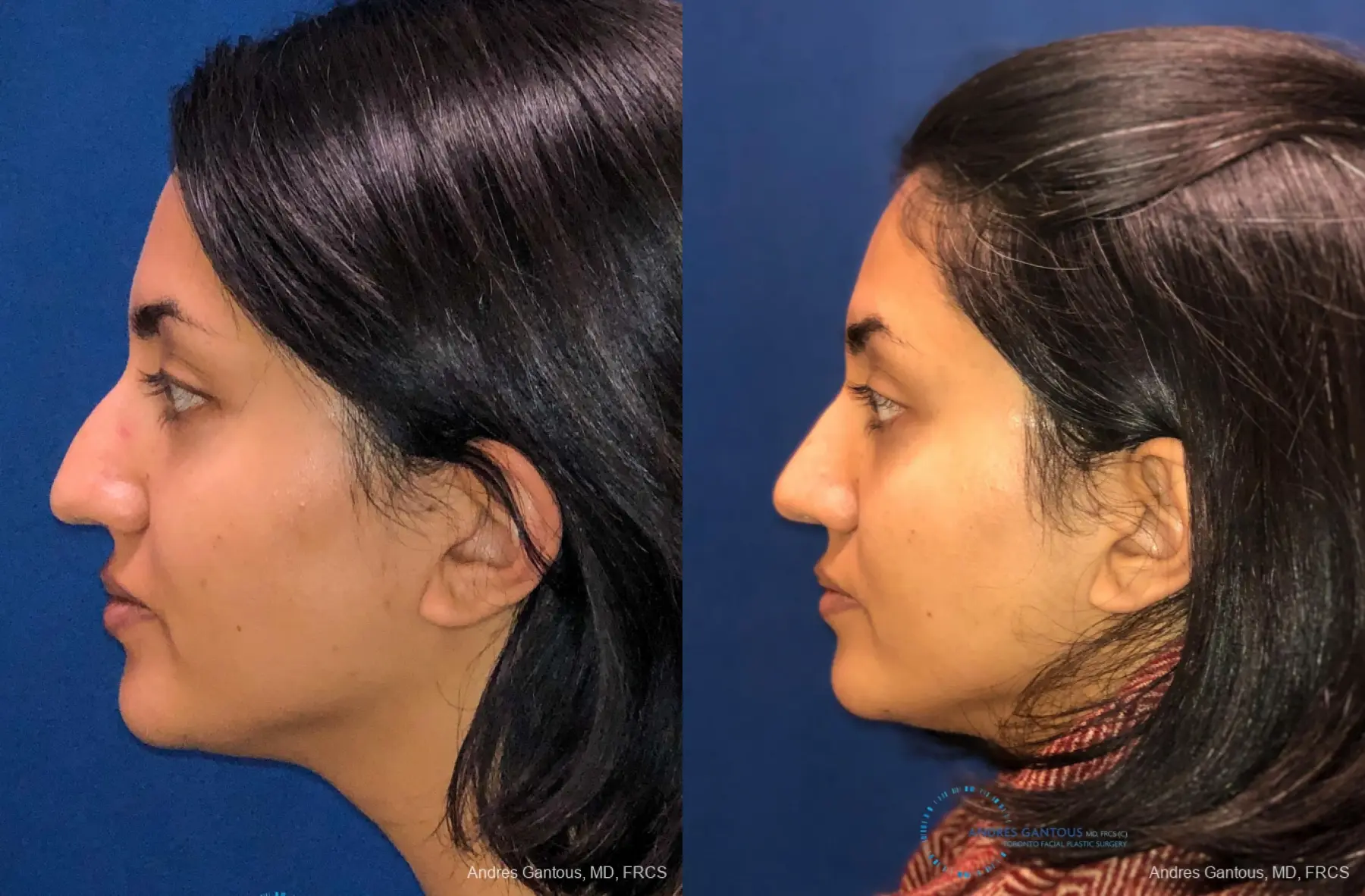 Rhinoplasty: Patient 80 - Before and After 6