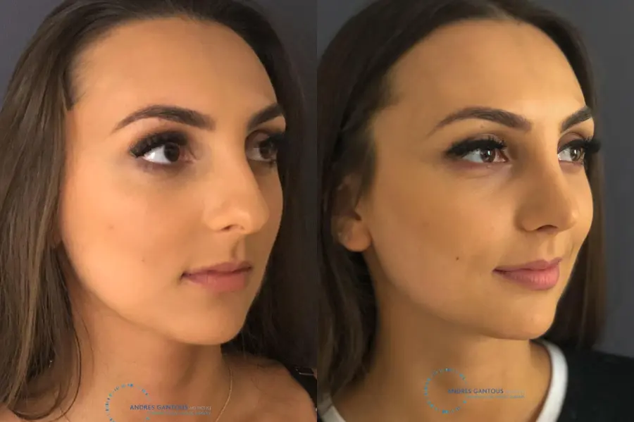 Rhinoplasty: Patient 11 - Before and After 4