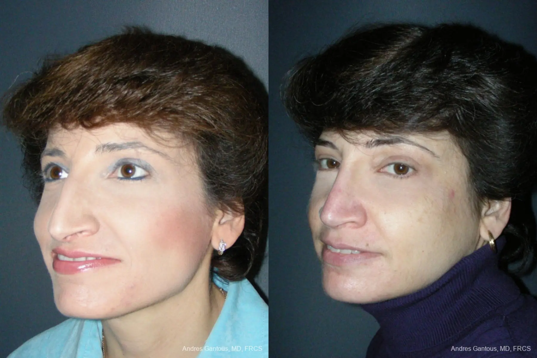 Rhinoplasty: Patient 49 - Before and After 2