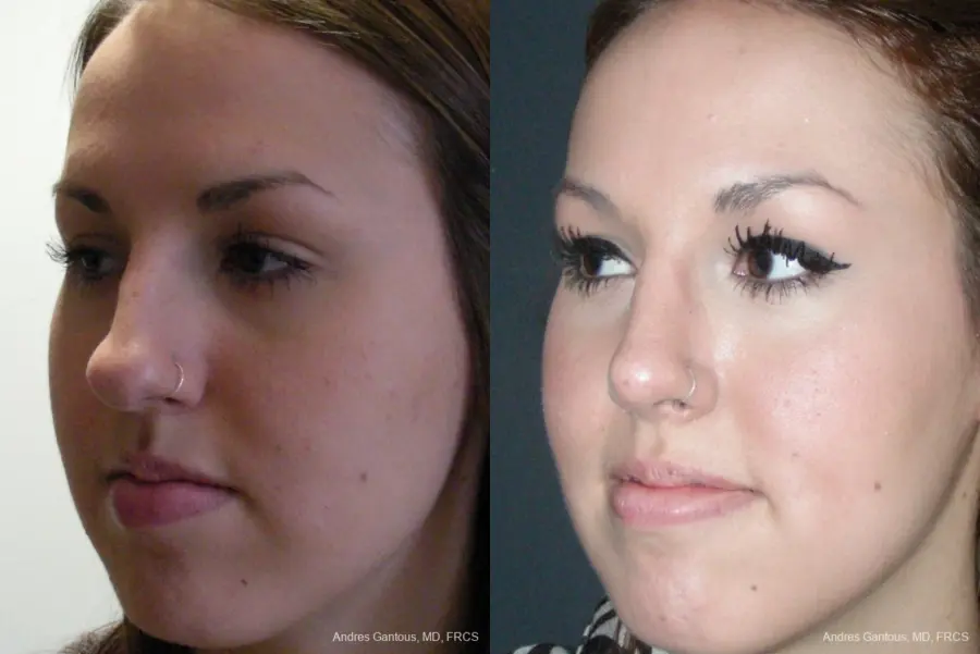 Rhinoplasty: Patient 21 - Before and After 3