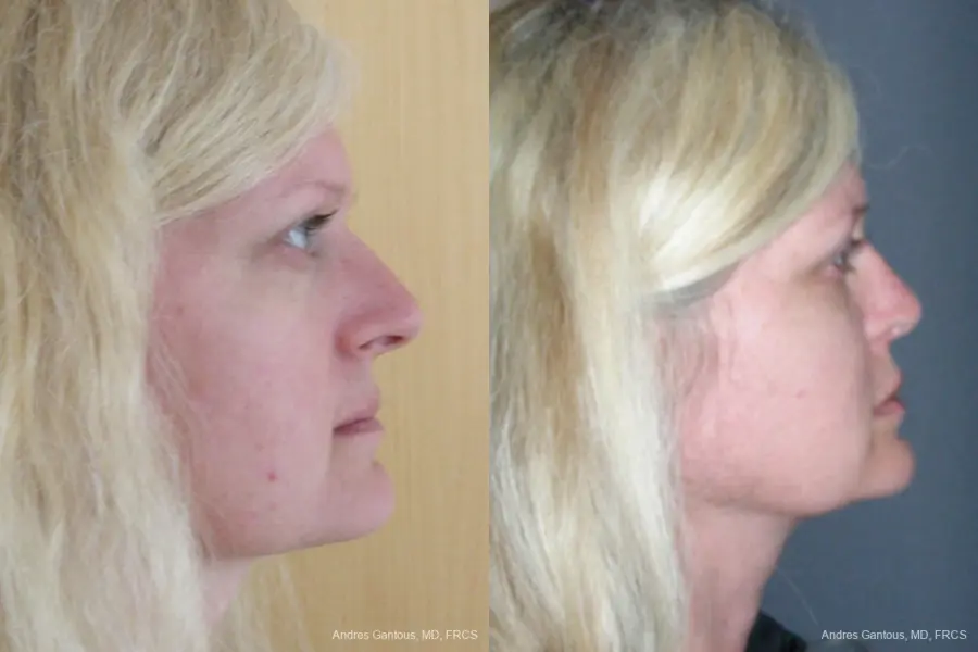 Rhinoplasty: Patient 44 - Before and After 3
