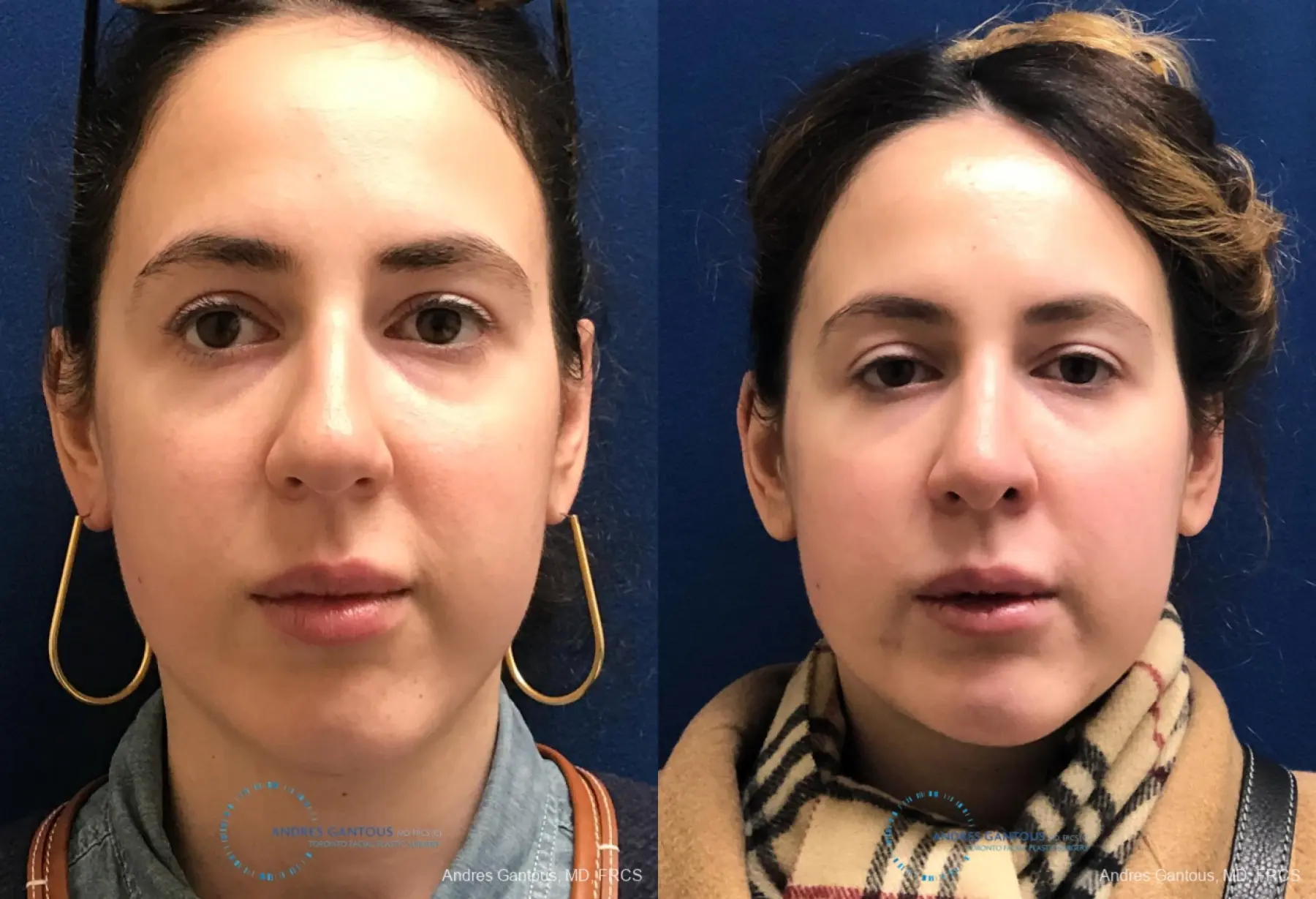 Rhinoplasty: Patient 82 - Before and After 1
