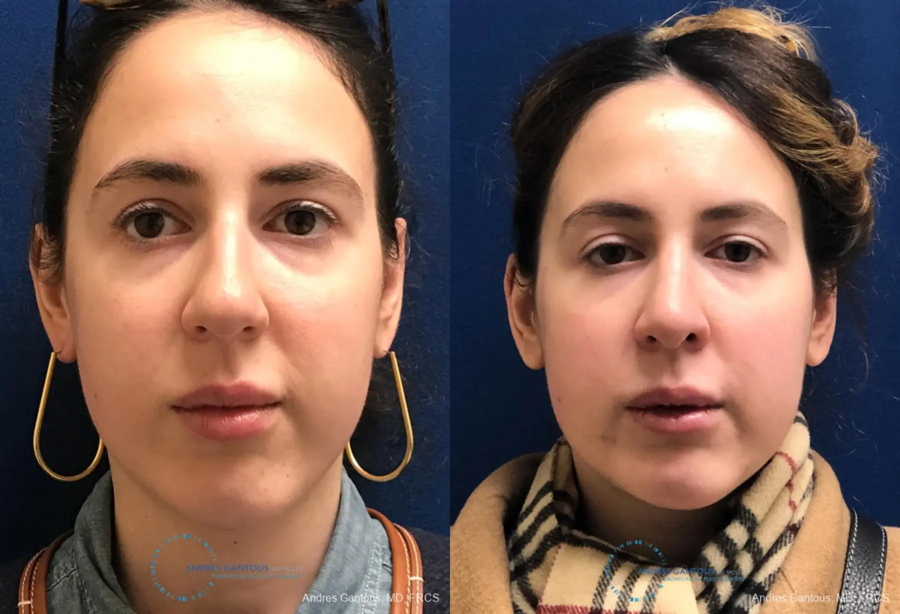 Rhinoplasty: Patient 82 - Before and After  