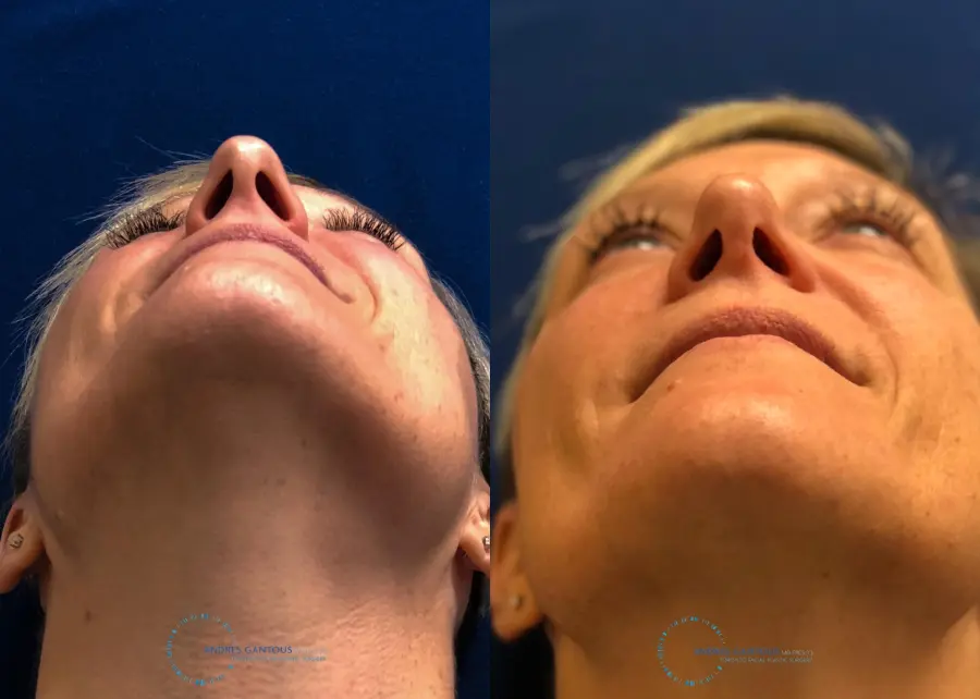 Rhinoplasty: Patient 68 - Before and After 2