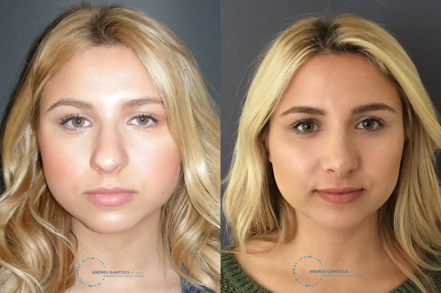 Rhinoplasty: Patient 70 - Before and After 1